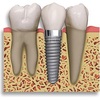 teeth whitening raleigh nc - Spectrum Family Dentistry