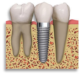 teeth whitening raleigh nc Spectrum Family Dentistry