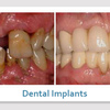 dental implants 89123 - Picture Box