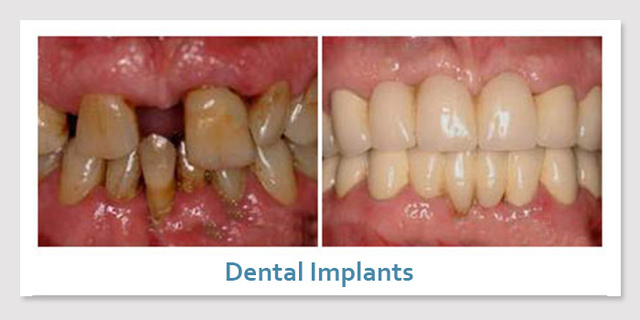 dental implants 89123 Picture Box