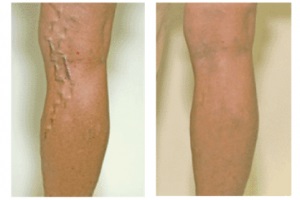 spider veins specialist valencia | 661-799-7459 Varicose Veins Valencia | 661-799-7459