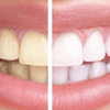 http://wellnesssystemreport.co.uk/white-light-smile-reviews/