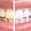 blanqueamiento 940x350 - http://wellnesssystemreport.co.uk/white-light-smile-reviews/