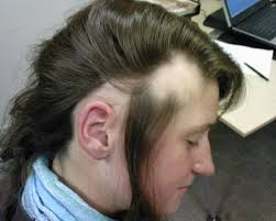 fgbfgbgf Natural Treatments for Hair Loss
