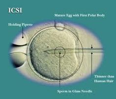 ICSI Treatment Picture Box