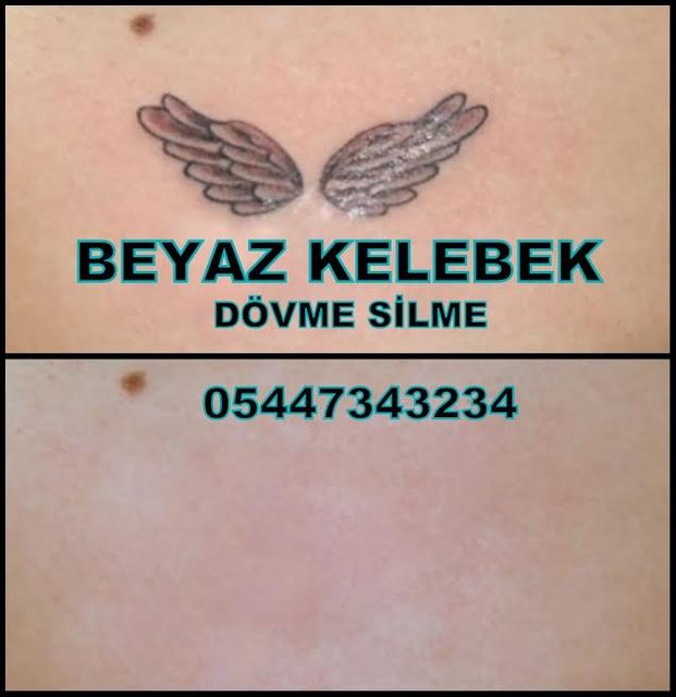 bakırköy dövme silme Dövme Silme Merkezi
