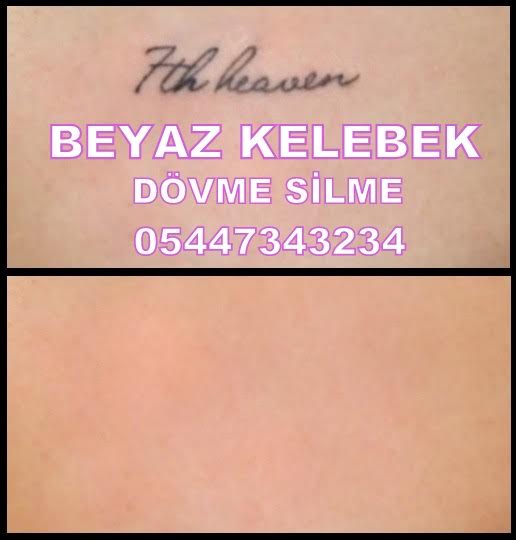 DÃ¶vme silme merkezi DÃ¶vme Silme NasÄ±l YapÄ±lÄ±r