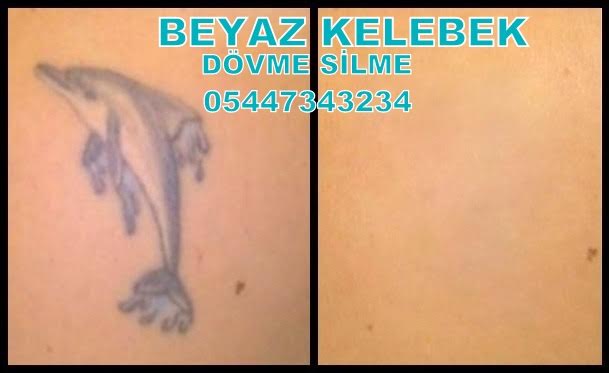 En BaÅŸarÄ±lÄ± DÃ¶vme Silme Merkezi En BaÅŸarÄ±lÄ± DÃ¶vme Silme Merkezi