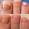 nail fungus treatment - Picture Box