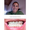 'Types Of Orthodontic Braces' - Bracesinfo