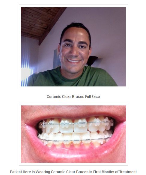 'Types Of Orthodontic Braces' Bracesinfo