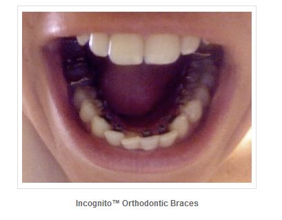 FireShot Screen Capture #008 - 'Types Of Orthodont Bracesinfo