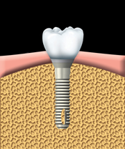 teeth implants tidental