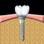 teeth implants - tidental