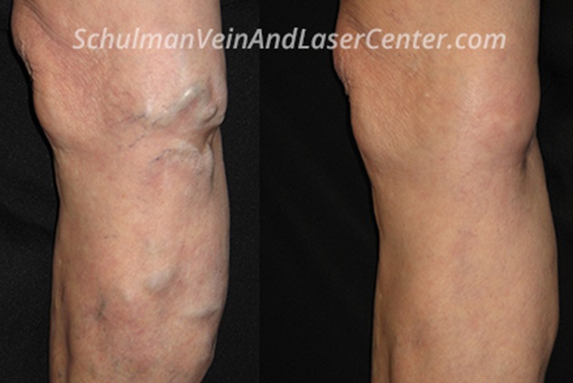 varicose vein treatment Schulman Vein and Laser Center
