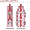 vein treatment long island - Schulman Vein and Laser Center