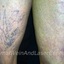 vein center long island - Schulman Vein and Laser Center