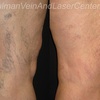 vein treatment long island - Schulman Vein and Laser Center