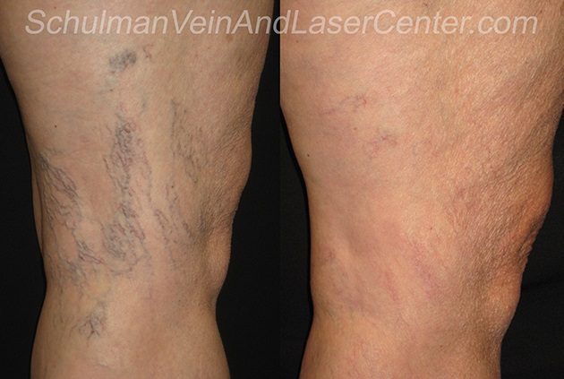 vein treatment long island Schulman Vein and Laser Center