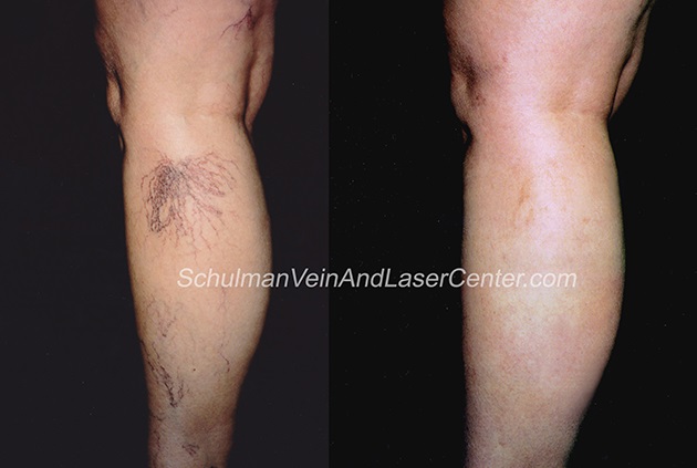 vein treatment Schulman Vein and Laser Center