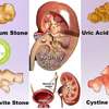 Kidney Stone Treatment In Pune - Shree Ayurved Clinic
