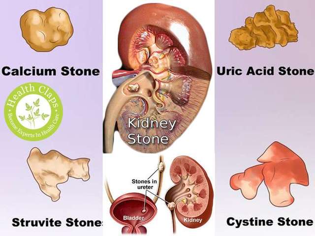 Kidney Stone Treatment In Pune Shree Ayurved Clinic