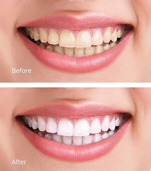 true-brilliance-teeth-white... - Anonymous