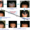 Hair Transplantation In Nagpur