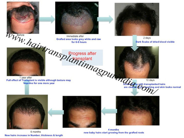 Hair Transplantation Treatment Hair Transplantation In Nagpur
