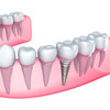 dental implants melbourne - Dentist James Peter