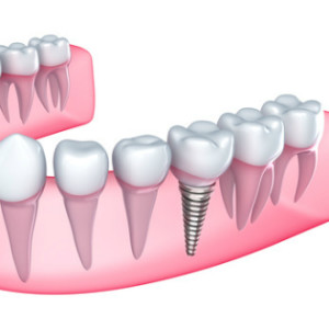 dental implants melbourne Dentist James Peter