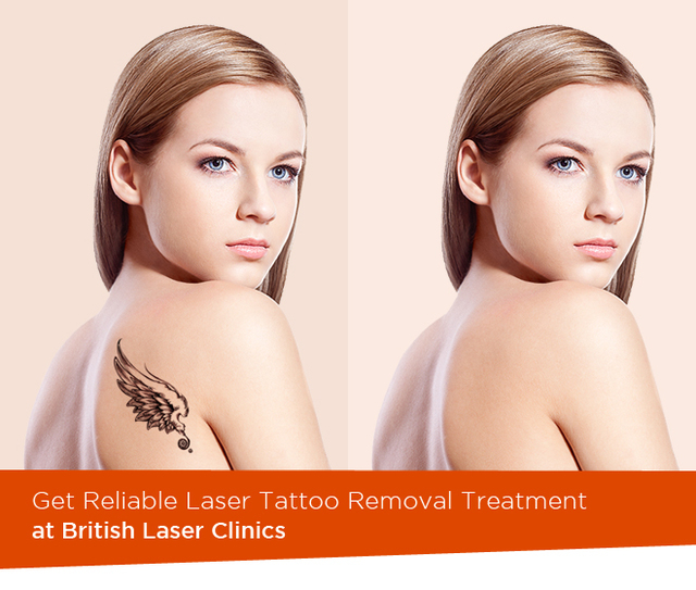 Get Reliable Laser Tattoo Removal Treatment British Laser Clinics
