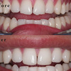 Implant Dentist Anaheim Hills - Dental Implants Anaheim Hills