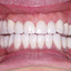 Best Implant Dentist Anahei... - Dental Implants Anaheim Hills