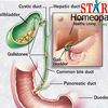 gallbladder stones - starhomeopathy