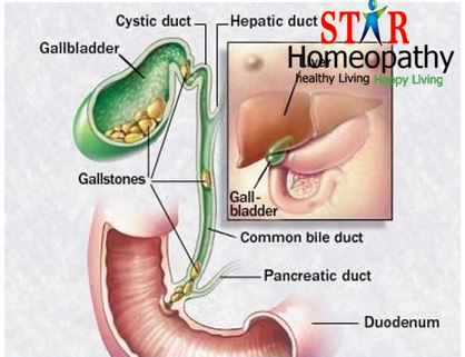 gallbladder stones starhomeopathy