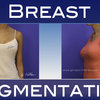 Breast Augmentation BodyCare - Picture Box