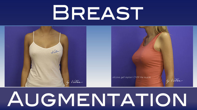 Breast Augmentation BodyCare Picture Box