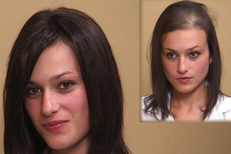 Follicle RX Growth Follicle RX Growth
