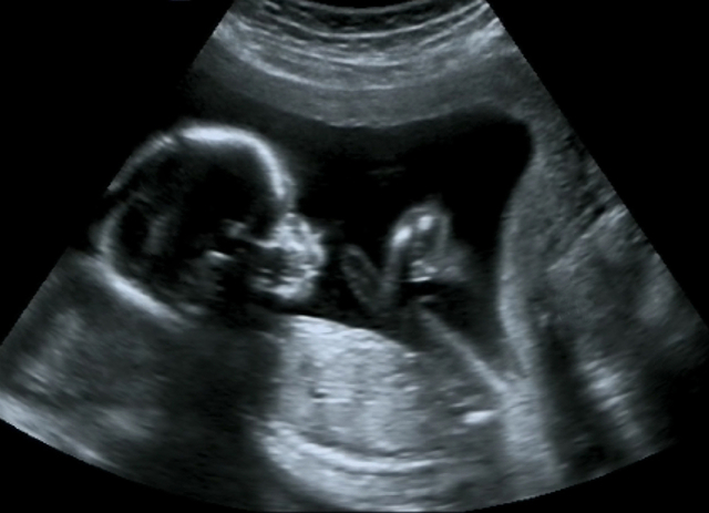 ultrasound-2 Techo