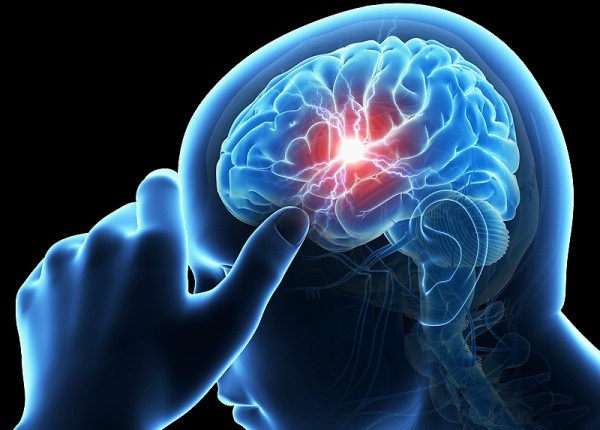 brain stroke Picture Box