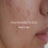 Simple Acne Treatment Prove... - Trending Videos