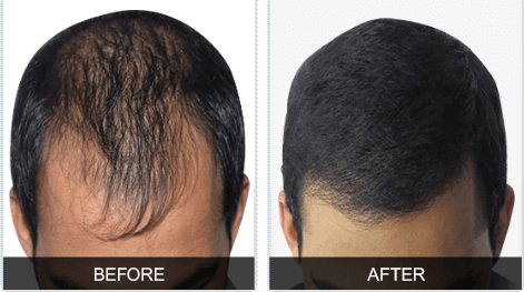 hair-regain-1 Nutralyfe Regain : Get Silky And Strong Hair
