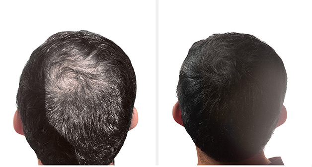before-after3 https://healthsupplementzone.com/shapiro-md-hair-shampoo/
