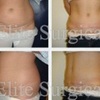 Abdominoplasty or Tummy Tuc... - Elite Surgical Ltd