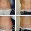 Abdominoplasty or Tummy Tuc... - Elite Surgical Ltd