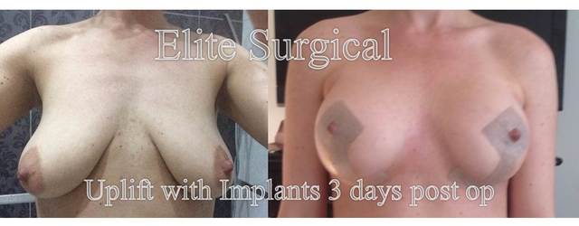 Breast Uplift (Mastopexy) Surgery at Elite Surgica Elite Surgical Ltd