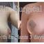 Breast Uplift (Mastopexy) S... - Elite Surgical Ltd