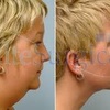 Chin and Cheek Reshaping at... - Elite Surgical Ltd