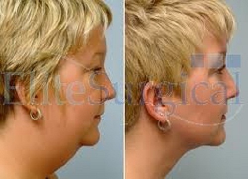 Chin and Cheek Reshaping at Elite Surgical Elite Surgical Ltd
